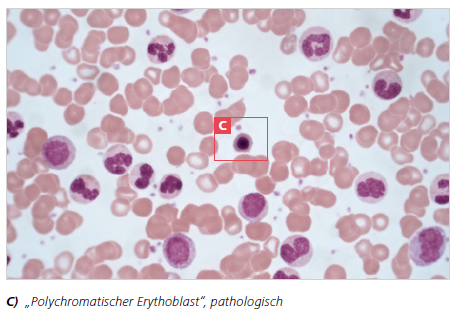 C) „Polychromatischer Erythoblast“, pathologisch