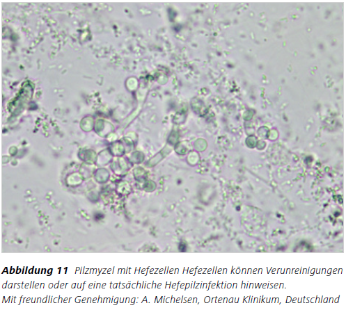 Abbildung 11 Pilzmyzel mit Hefezellen Hefezellen können Verunreinigungen
darstellen oder auf eine tatsächliche Hefepilzinfektion hinweisen. Mit freundlicher Genehmigung: A. Michelsen, Ortenau Klinikum, Deutschland
