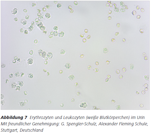 Abbildung 7 Erythrozyten und Leukozyten (weiße Blutkörperchen) im Urin
Mit freundlicher Genehmigung: G. Spengler-Schulz, Alexander Fleming Schule, Stuttgart, Deutschland