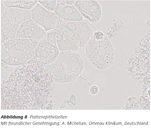 Abbildung 8 Plattenepithelzellen Mit freundlicher Genehmigung: A. Michelsen, Ortenau Klinikum, Deutschland